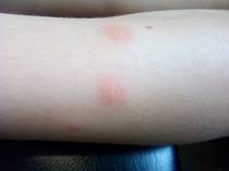 insect bites does anyone know