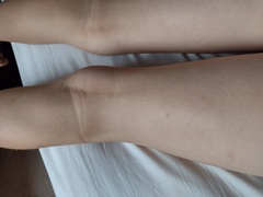 To think it isn't chickenpox after all?