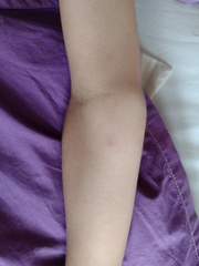 To think it isn't chickenpox after all?