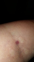New bruising on old blood taking sites