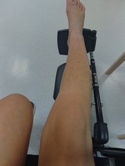 Diet & broken limbs/limited mobility (Terrified of weight gain)