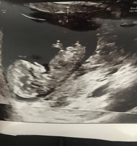 Gender nub predictions?