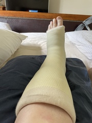Diet & broken limbs/limited mobility (Terrified of weight gain)