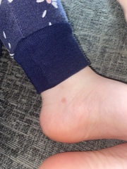 Is this the start of chicken pox? Or bites?