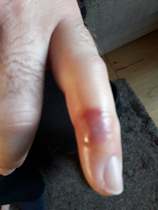 Is this a wasp sting?