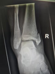 Diet & broken limbs/limited mobility (Terrified of weight gain)