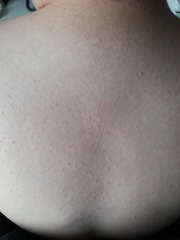 Any Drs or Nurses - Back Rash with Pics