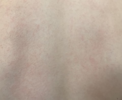 Rash