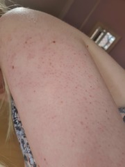 How to get rid of my 'chicken skin' ... see photos!