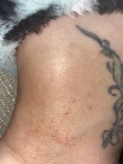 Is this psoriasis or eczema?