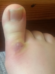 Insect bites (pictures) - anyone an expert on reactions to these?