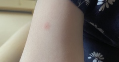 Is this the start of chicken pox? Or bites?