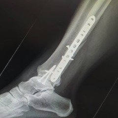 Diet & broken limbs/limited mobility (Terrified of weight gain)