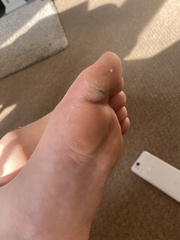 DD’s toe abscess