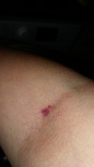 New bruising on old blood taking sites