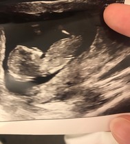 Gender nub predictions?