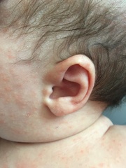 Baby acne or Cows Milk Allergy? Photos inc.