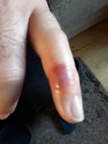 Is this a wasp sting?