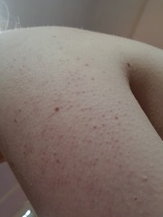 How to get rid of my 'chicken skin' ... see photos!