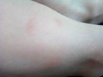 insect bites does anyone know