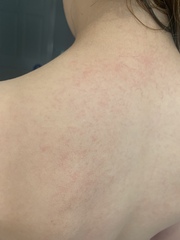 Rash