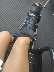 Diet & broken limbs/limited mobility (Terrified of weight gain)