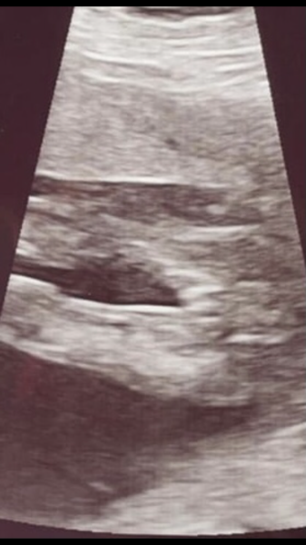Anyone had a gender scan at 16 weeks?