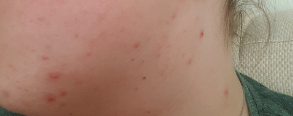 I'm 31 and my skin has gone back to being a teenager!