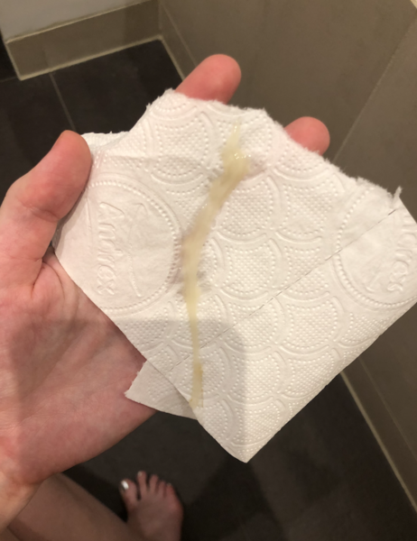 Am I losing my mucus plug? (WARNING: photos attached)
