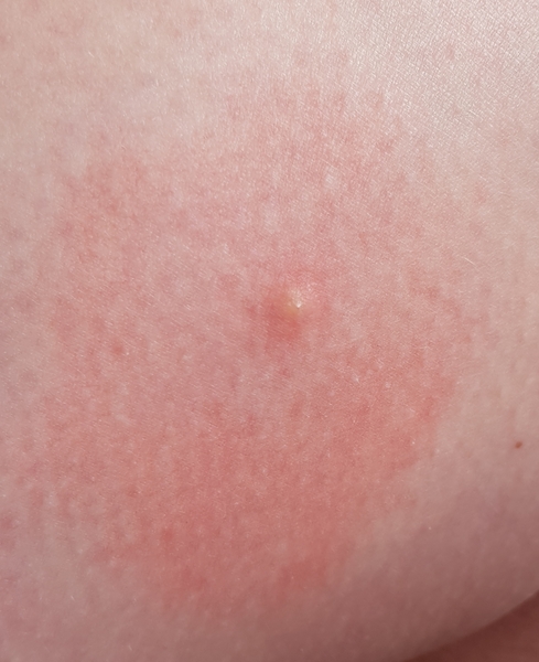 Bites and itchy reactions