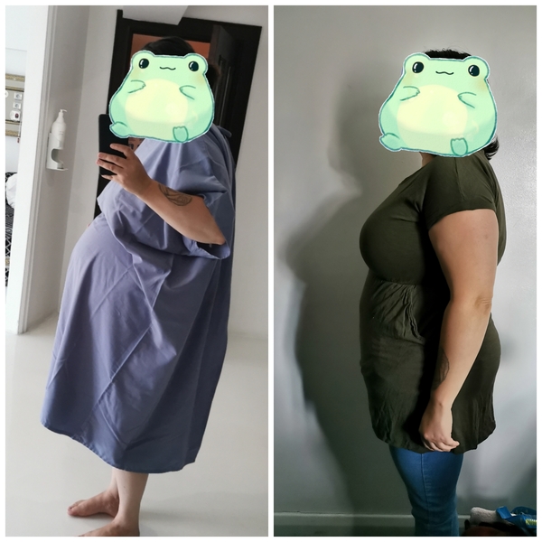 I've had a gastric sleeve!