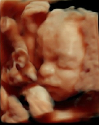 High Risk for Down Syndrome/Edwards-Positive Stories needed please!