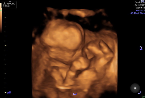 Due February 2022 (thread 3)