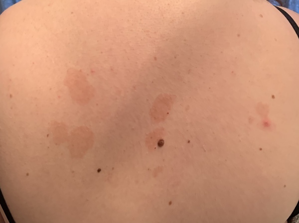 Could this be skin cancer? Extremely anxious