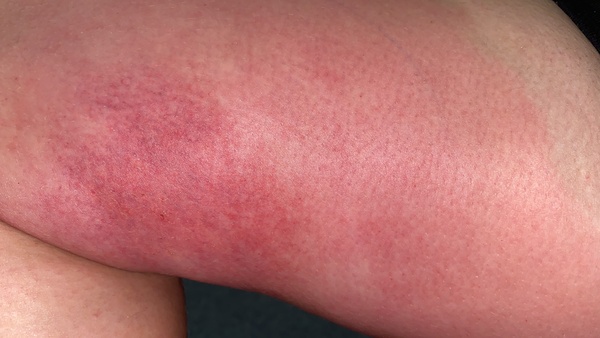 Cellulitis