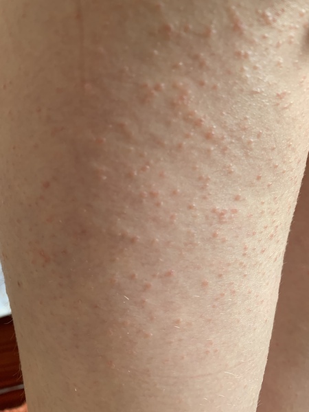 9 year old DD awful body rash - doctor doesn’t know what it is