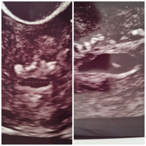Early pregnancy complications..
