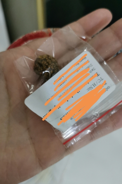 Any sporners want to see my gallstone?