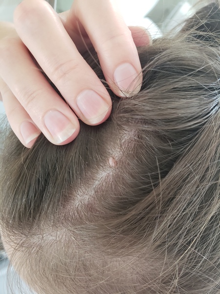 Worried about growth on scalp