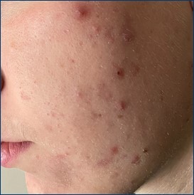 Teenage Acne - what can the GP do?