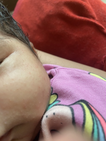 Newborn rash