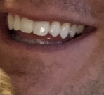 Adult braces