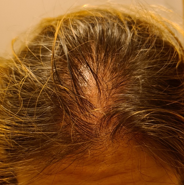 Losing my hair