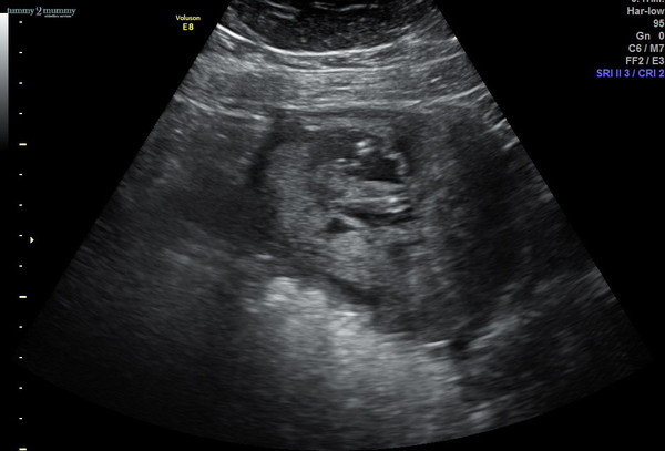 Could anyone help to identify whether we're having a boy or girl please?