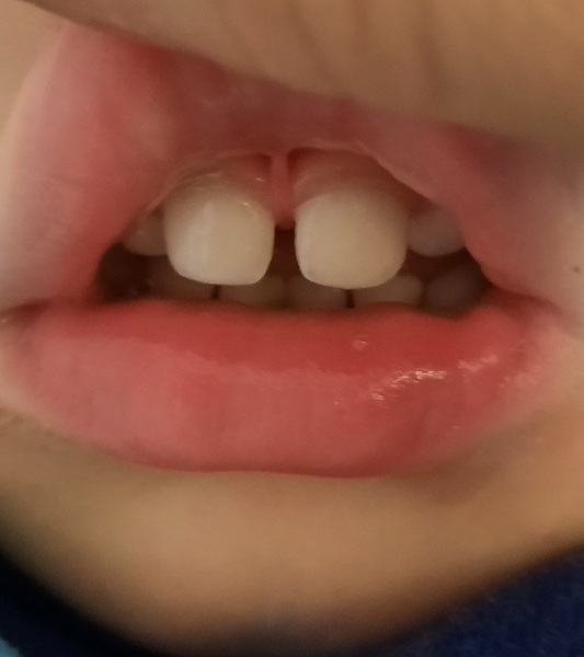 *Pic included* - is this lip tie?