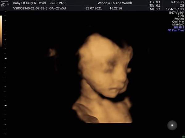 High Risk for Down Syndrome/Edwards-Positive Stories needed please!