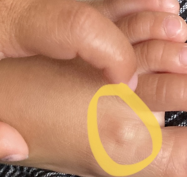 Anyone had this before? Little bumpy bit on child’s toe