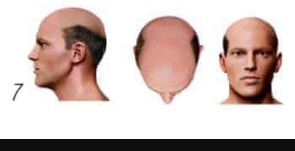 To think that bald does not mean completely hair-less?