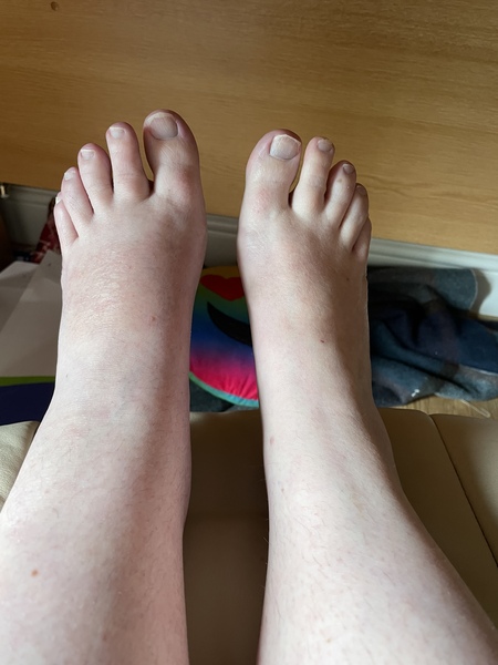 Diet & broken limbs/limited mobility (Terrified of weight gain)