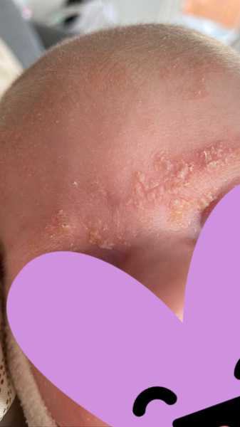 Is this cradle cap?